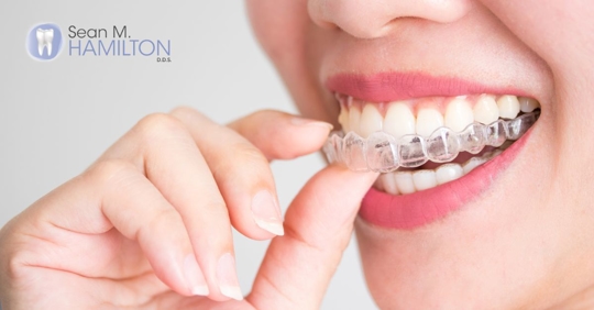 Invisalign being put into mouth